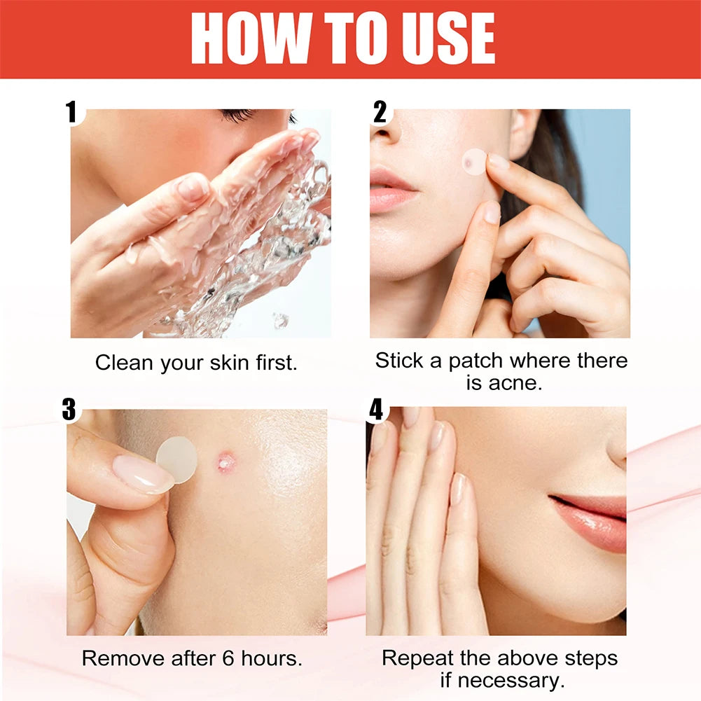 Zelixo Acne Pimple Patch — 144pcs Invisible Healing Spot Sticker for Face