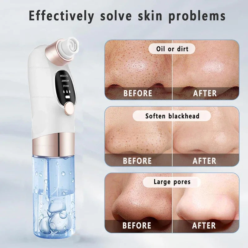 Zelixo Blackhead Remover Pore Vacuum — Water Cycle USB Rechargeable Pore Cleaner