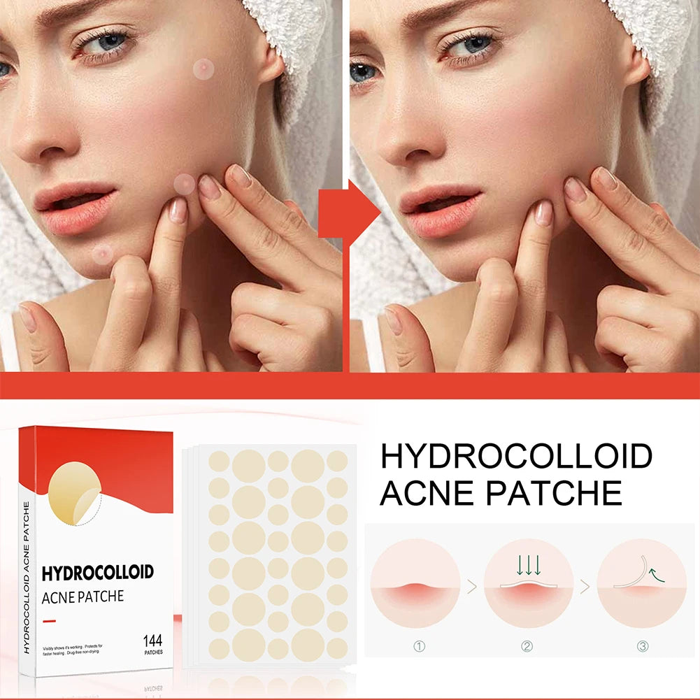 Zelixo Acne Pimple Patch — 144pcs Invisible Healing Spot Sticker for Face